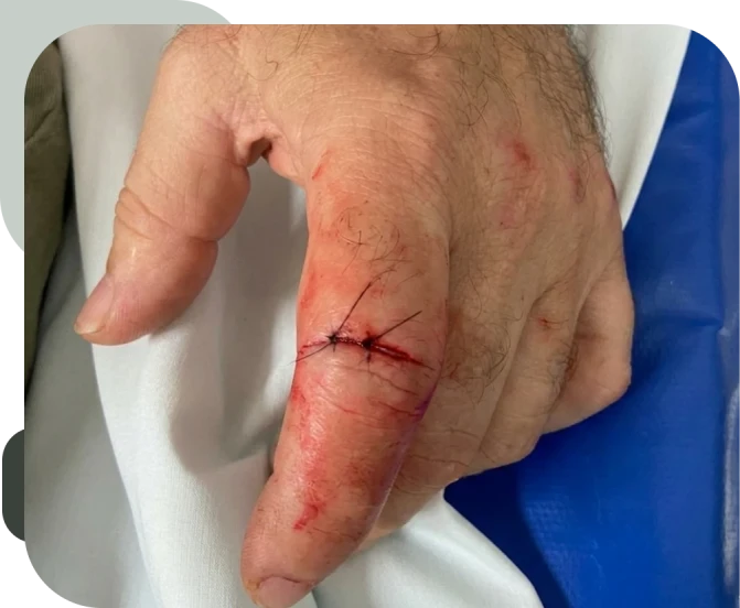 Tendões Extensor