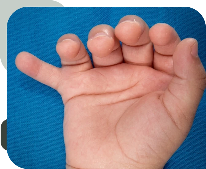 O Que é Polidactilia?