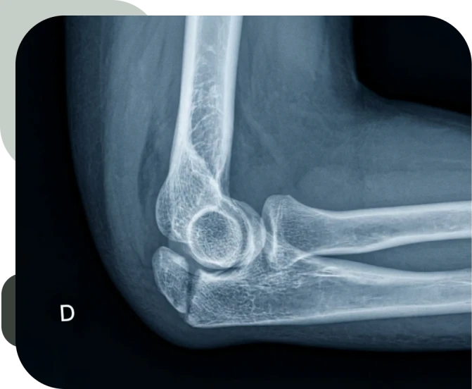 Opções Cirúrgicas para Recuperação do Cotovelo